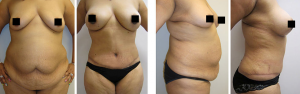 abdominoplastie