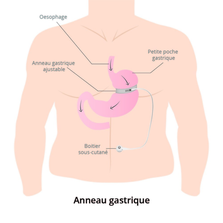 glissement anneau gastrique