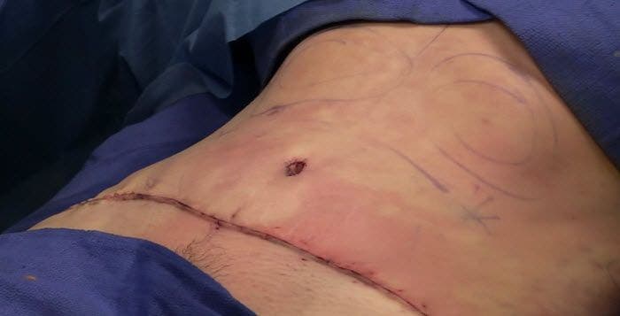 Gastrectomie verticale (Sleeve) - Chirurgie Perte de Poids